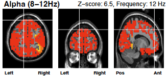 Screenshot 2024-10-28 at 3.02.35 PM alphs wave brain scan before neurofeedback therapy
